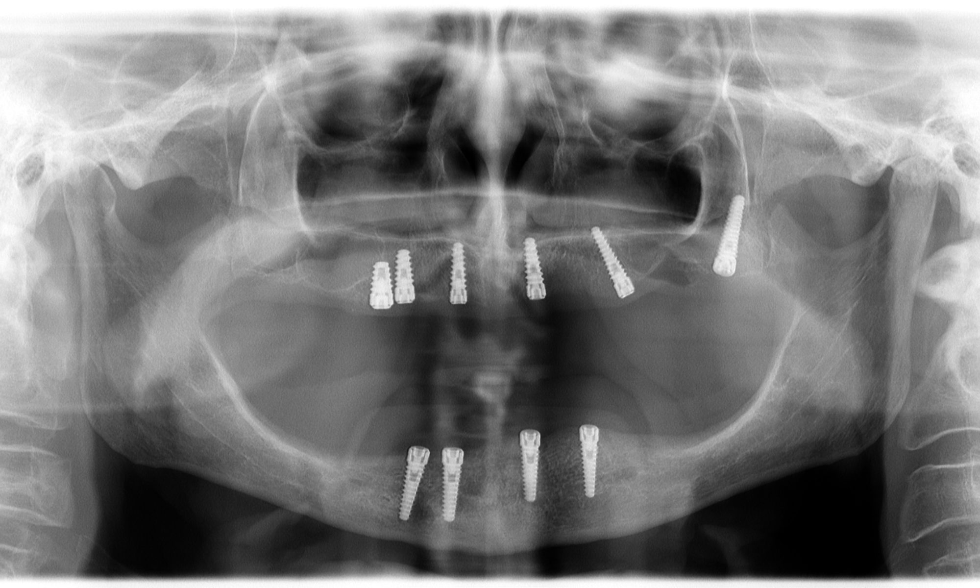 dental implants panorama city ca