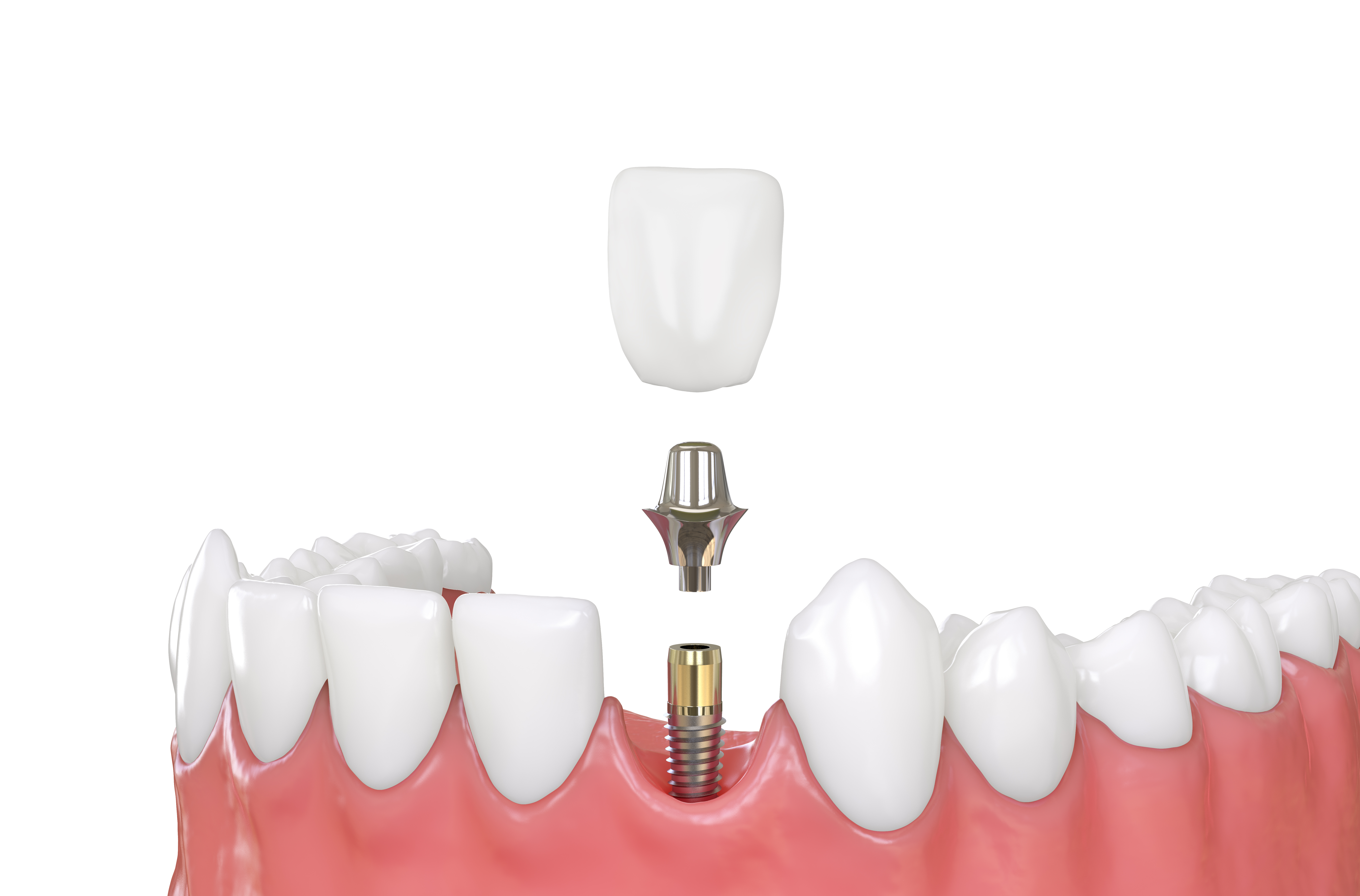 dental implants van nuys ca